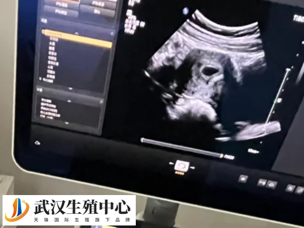 黄体功能不足会导致FSH偏高