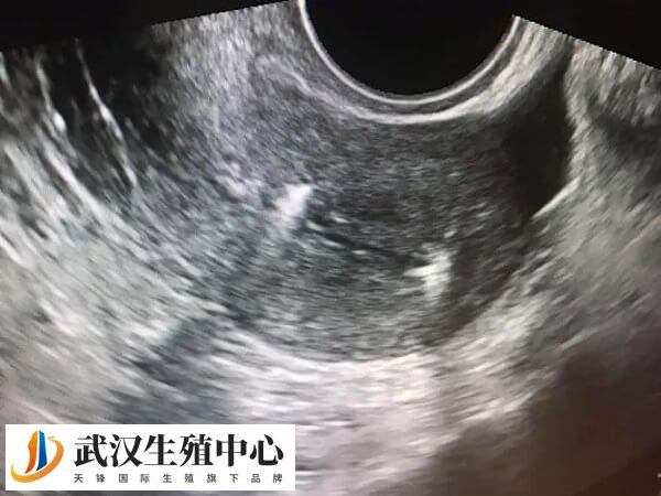 取卵后如何避免发生宫腔分离