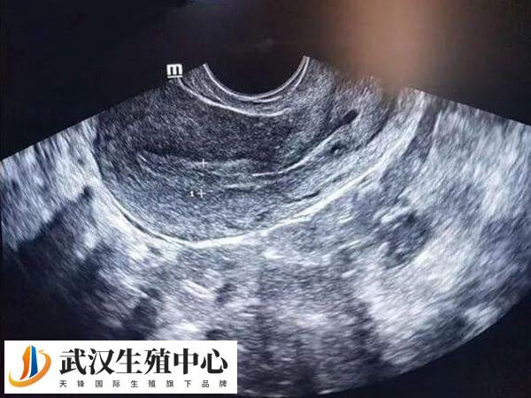 做三代试管胚胎多次不着床怎么回事